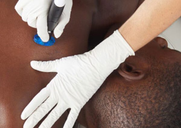 Men's HydraFacial Back